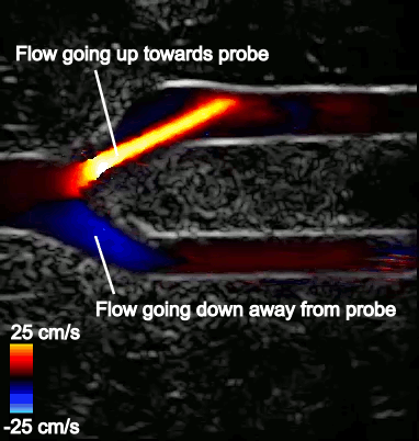 Blood flow speed in the artery is shown using shades of blue and red, with red depicting flow going up towards the probe, and blue depicting flow going down, away from the probe. The brighter colors indicate faster flow according to the color scale on the bottom left. Tissue structures can be visualized using the surrounding gray-scale image, with bright regions indicating strong reflectors such as vessel walls.
